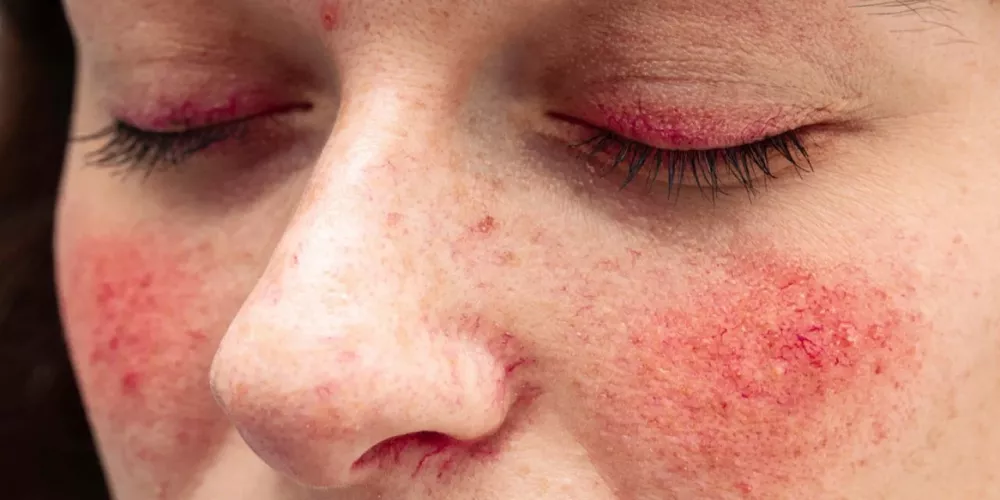 الذئبة الحمراء